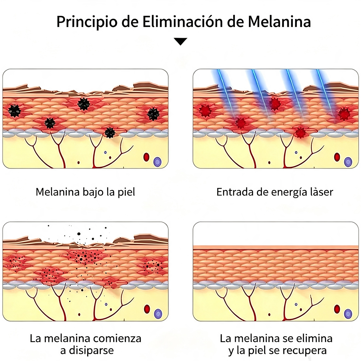 El Bolígrafo Láser De Picosegundos Recargable Elimina El Pig