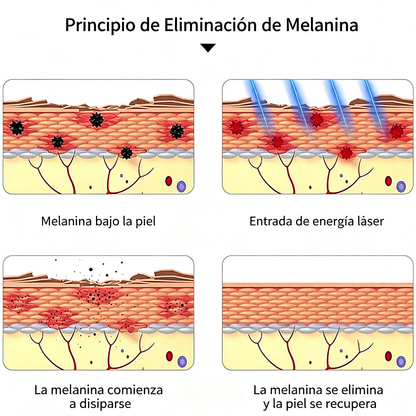 El Bolígrafo Láser De Picosegundos Recargable Elimina El Pig